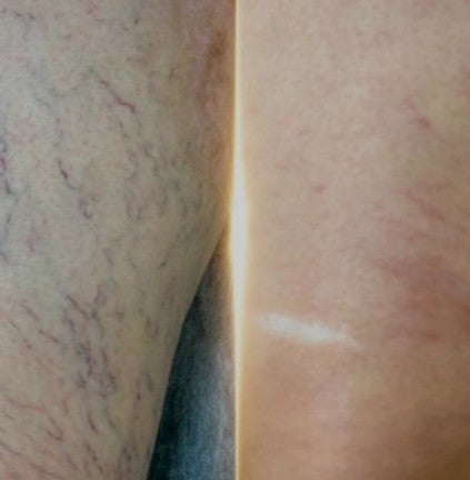 Agende Avaliação para Luz Pulsada secagem de vazinhos | Estetica CM