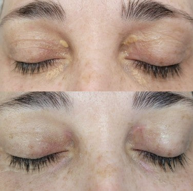 Agende Avaliação Jato de Plasma Xantelasma Olhos | Estetica CM