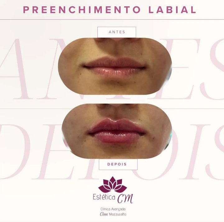 Preenchimento Labial | Estetica CM