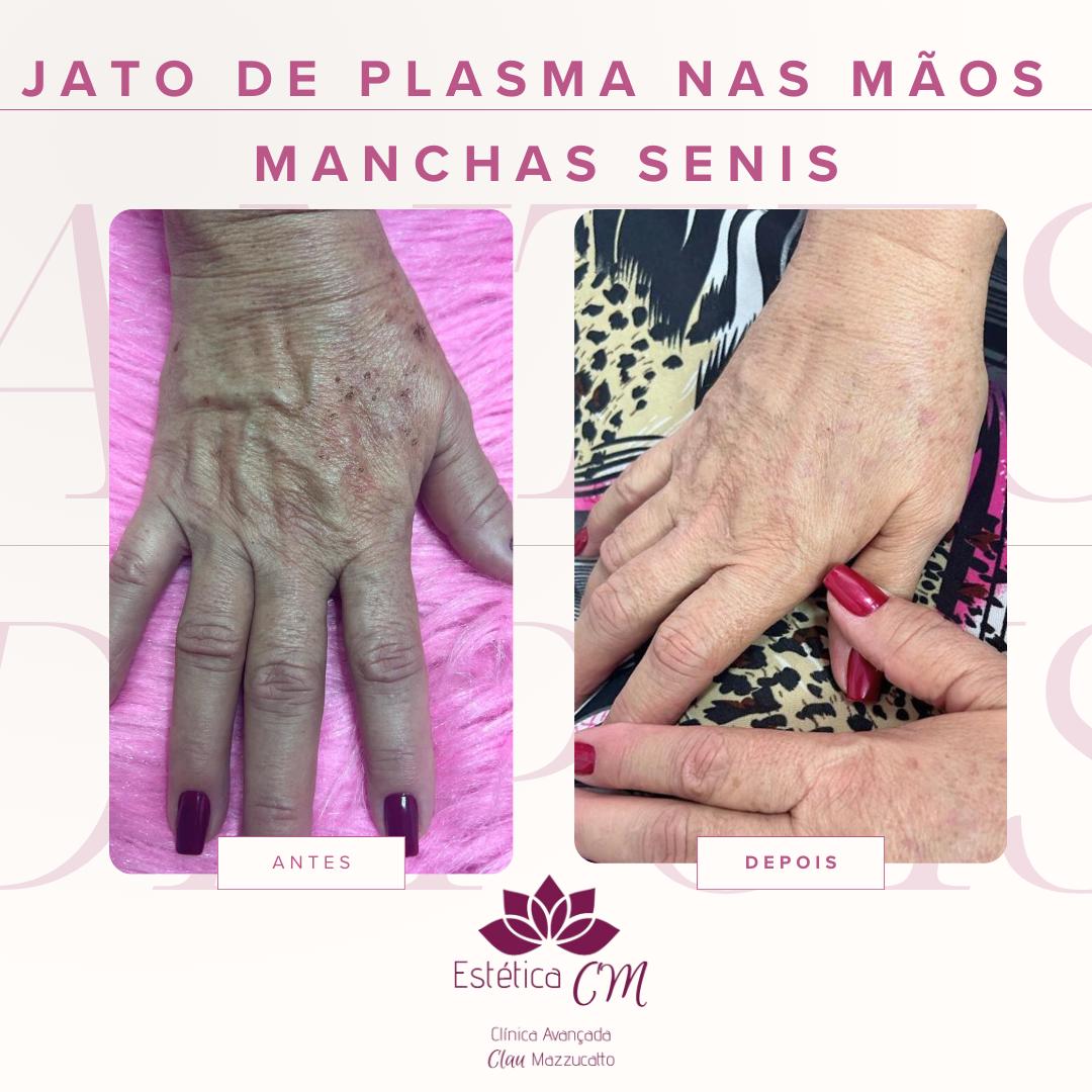 Agenda avaliação para Jato de Plasma Mãos | Estetica CM