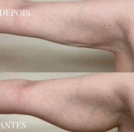 Agende Avaliação gratuita para Ultrassom Microfocado HERUS BRAÇOS | Estetica CM