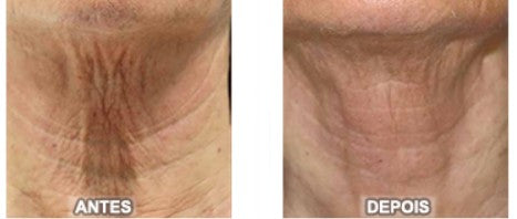 Agende Avaliação gratuita para Ultrassom Microfocado HECUS FACE E PESCOÇO