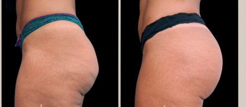 Agende Avaliação gratuita Ultrassom Microfocado HERUS GLÚTEOS | Estetica CM