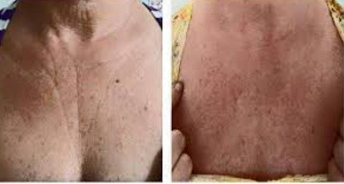 Agende Avaliação gratuita para Ultrassom Microfocado HERUS COLO| Estetica CM