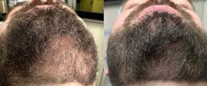 Agenda avaliação para Intradermoterapia para Barba | Estetica CM