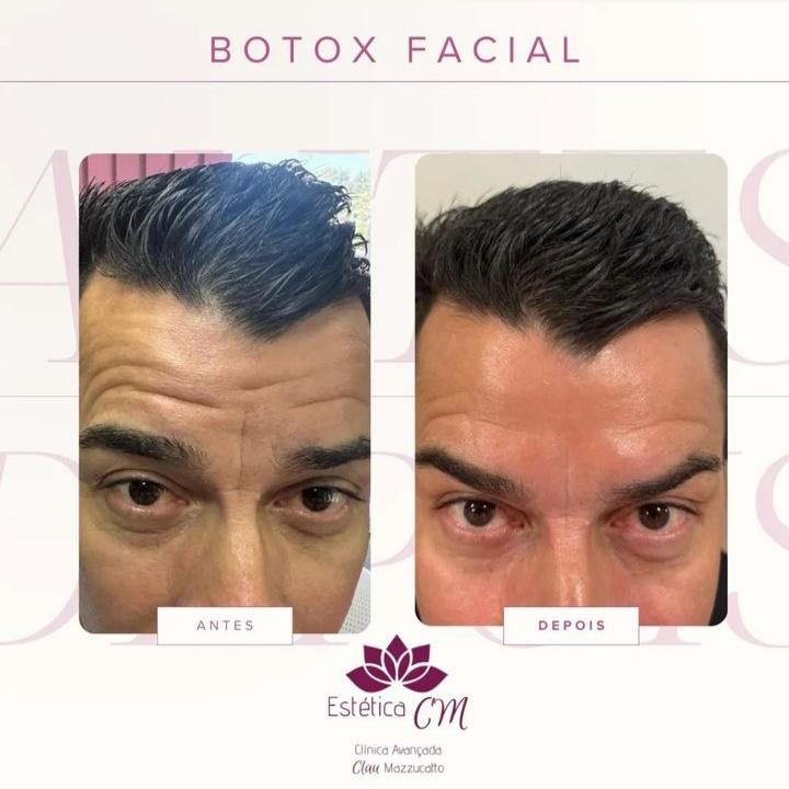 Agende Avaliação para Botox 10 Ul | Estetica CM