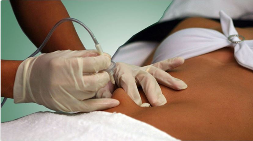 Agende Tratamento Celulite com Vacuoterapia + Carbox | Estetica CM