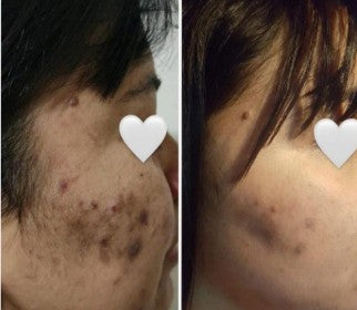 Agende avaliação para Peeling Retinóico Face e Colo | Estetica CM