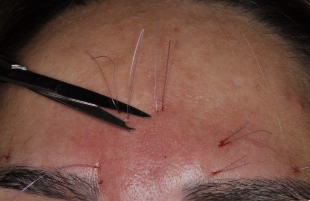 Glabela Fios de Sustentação liso com 6 fios | Estetica CM