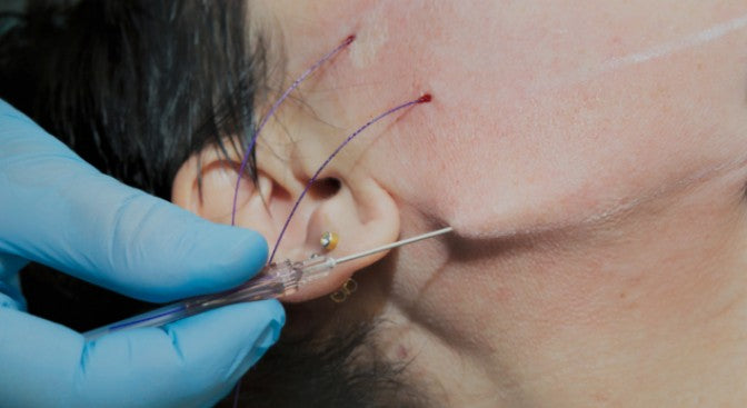 Fios de Sustentação 4 fios | Estetica CM