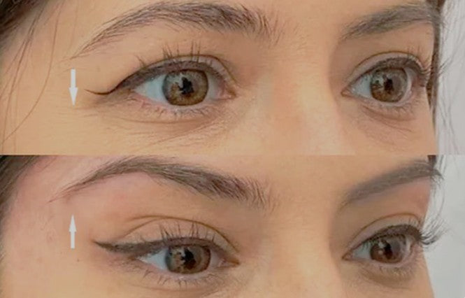 Agende avaliação para Fios de Sustentação Fox Eyes | Estetica CM