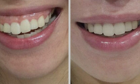 Agende Avaliação Gratuita para Botox Gengival | Estetica CM