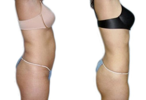 Agende avaliação para Hidrolipoclasia | Estetica CM