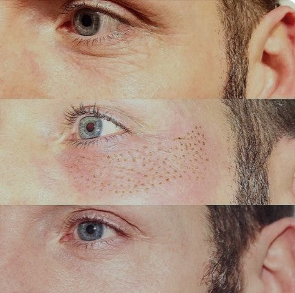 Agende avaliação para Jato de Plasma Orbicular Olhos | Estetica CM