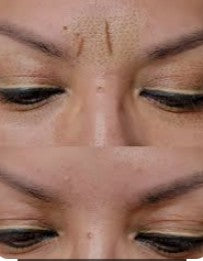 Agende Avaliação Jato de Plasma Glabela | Estetica CM