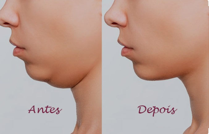 Agende Avaliação para Lipo de Papada sem corte | Estetica CM