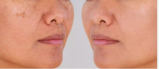 Agende avaliação Intradermoterapia Melasma | Estetica CM