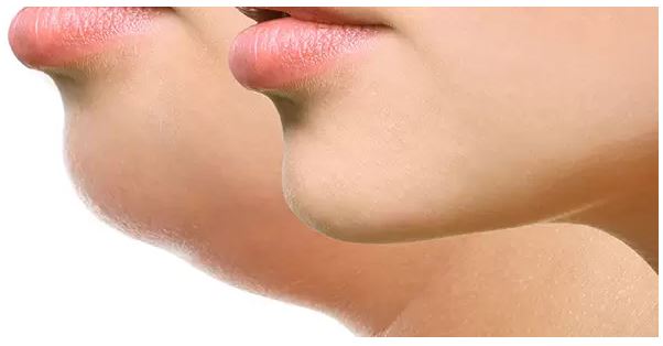 Agende Avaliação para Radiofrequência Papada | Estetica CM