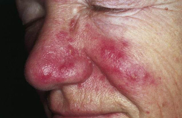 Agende avaliação para Lyra Rosacea | Estetica CM