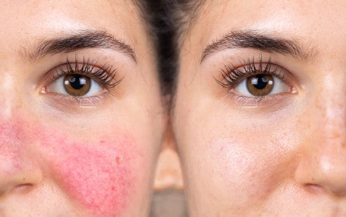 Agende avaliação para Lyra Rosacea | Estetica CM