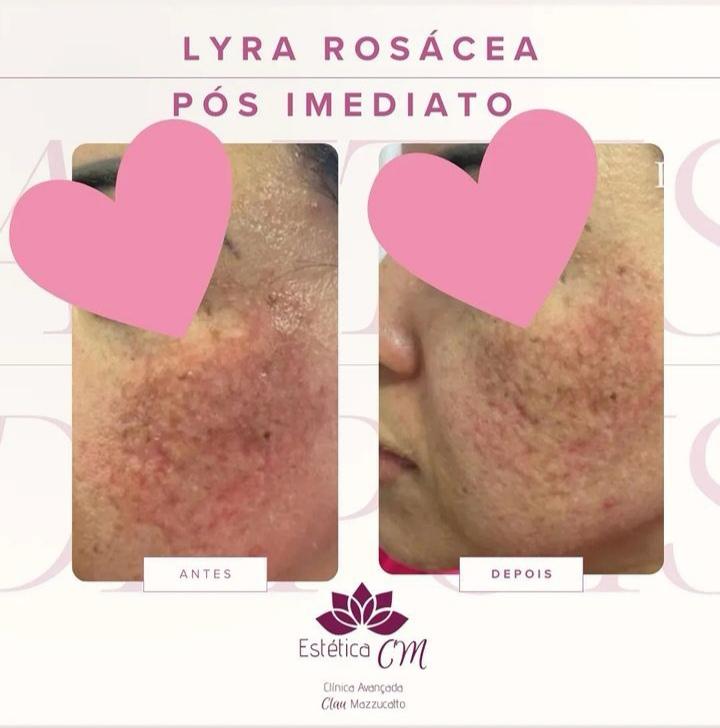 Agende avaliação para Lyra Rosacea | Estetica CM