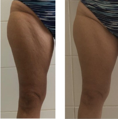 Agende Avaliação gratuita para Ultrassom Microfocado HERUS JOELHOS | Estetica CM
