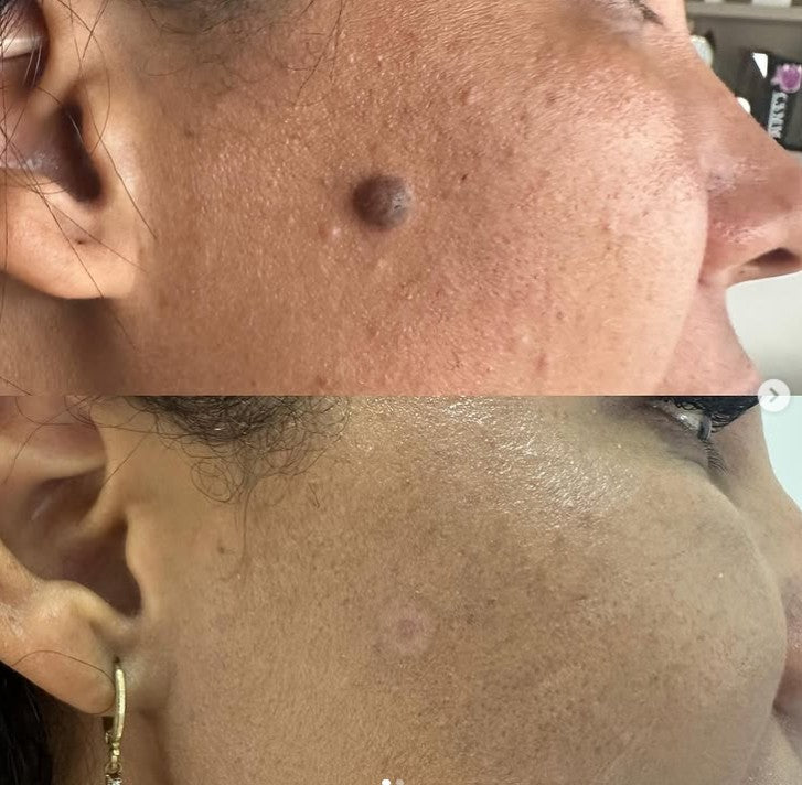 Agende Avaliação Jato de Plasma Extração de Verrugas | Estetica CM