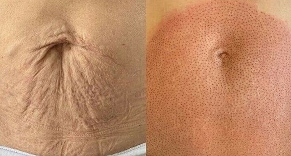 Agende avaliação Jato de Plasma Estrias | Estetica CM