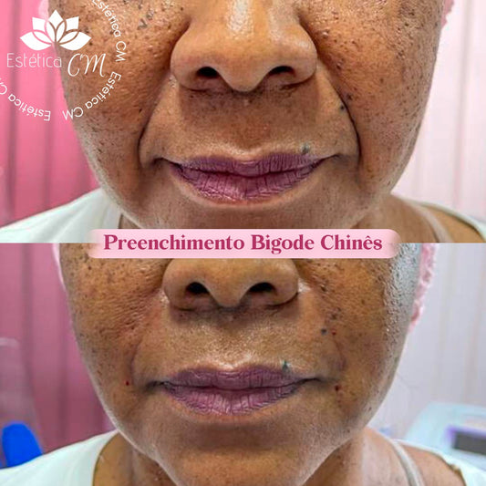 Agendamento Avaliação gratuita para Preenchimento Bigode Chines| Estetica CM