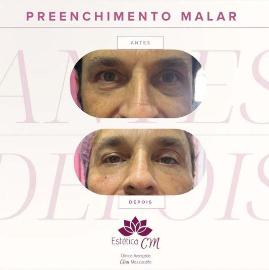 Preenchimento Malar | Estetica CM