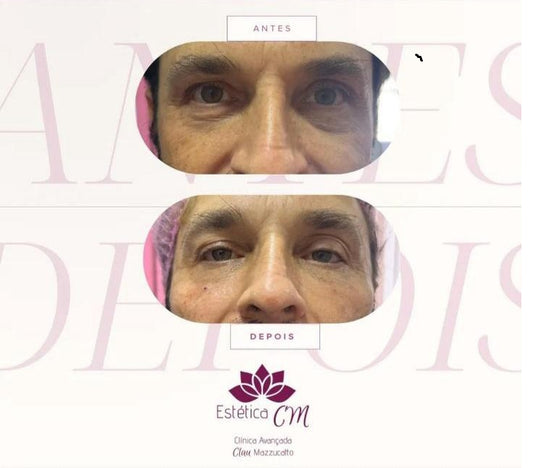 Agende Avaliação Preenchimento no Zigomático | Estetica CM