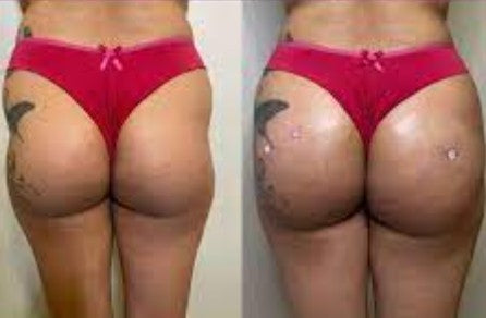 Preenchimento Corporal Plasma Gel | Clinica Estetica CM Barueri Bethaville