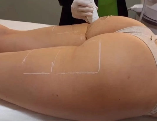 Agende Avaliação gratuita Ultrassom Microfocado HERUS GLÚTEOS | Estetica CM