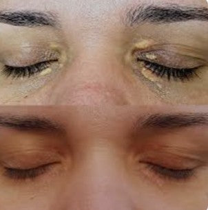 Agende Avaliação Jato de Plasma Xantelasma Olhos | Estetica CM