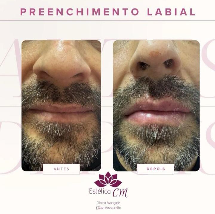 Preenchimento Labial | Estetica CM