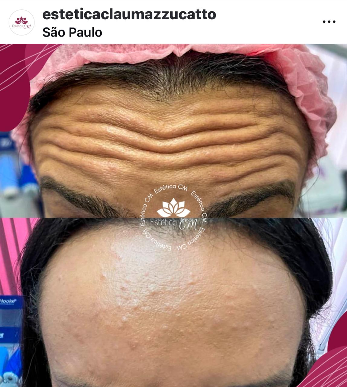 Agende Avaliação para Botox 20 Ul Intermediário | Estetica Clau Mazzucatto