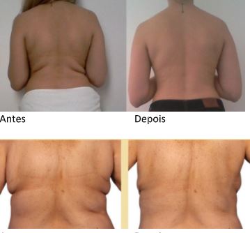 Agende avaliação para Criolipólise Costas | Estetica CM