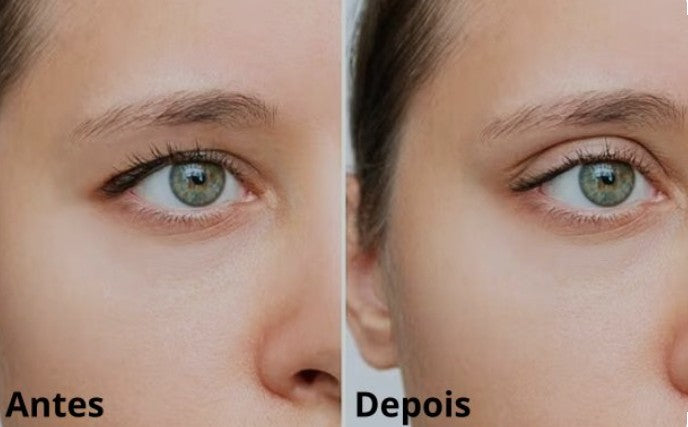 Agende avaliação Jato de Plasma Blefoplastia sem Corte | Estetica CM