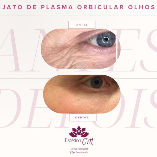 Agende avaliação para Jato de Plasma Orbicular Olhos | Estetica CM