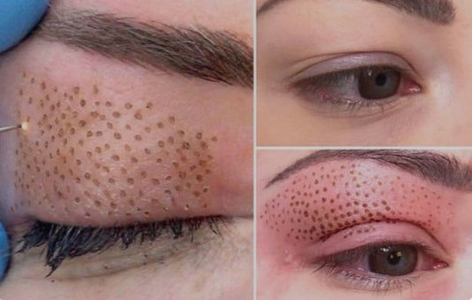 Agende avaliação Jato de Plasma Blefoplastia sem Corte | Estetica CM