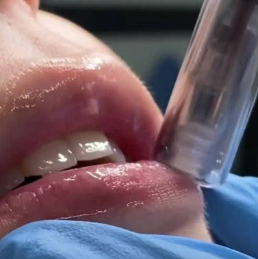 Agende avaliação para Microagulhamento Labial | Estetica CM