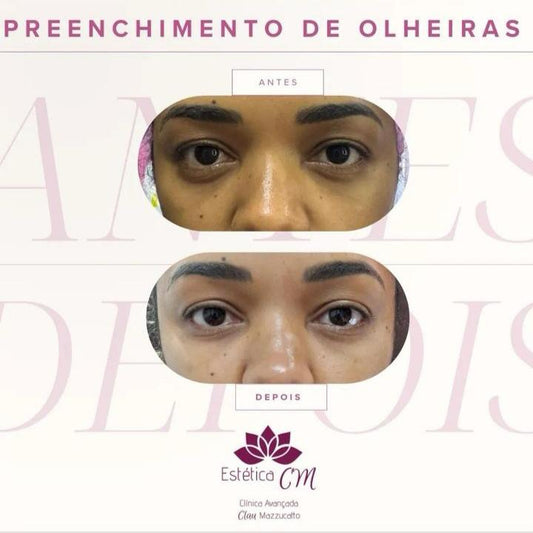 Agende avaliação para Preenchimento Olheira | Estetica CM