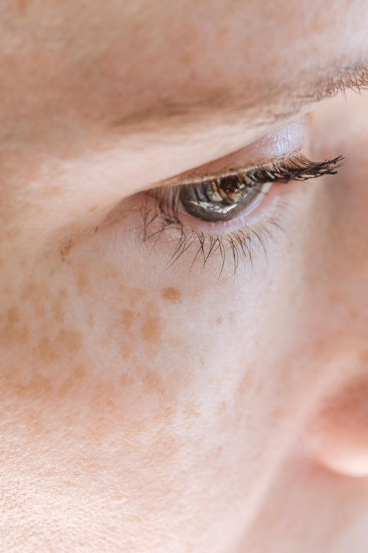 Agende avaliação Intradermoterapia Melasma | Estetica CM