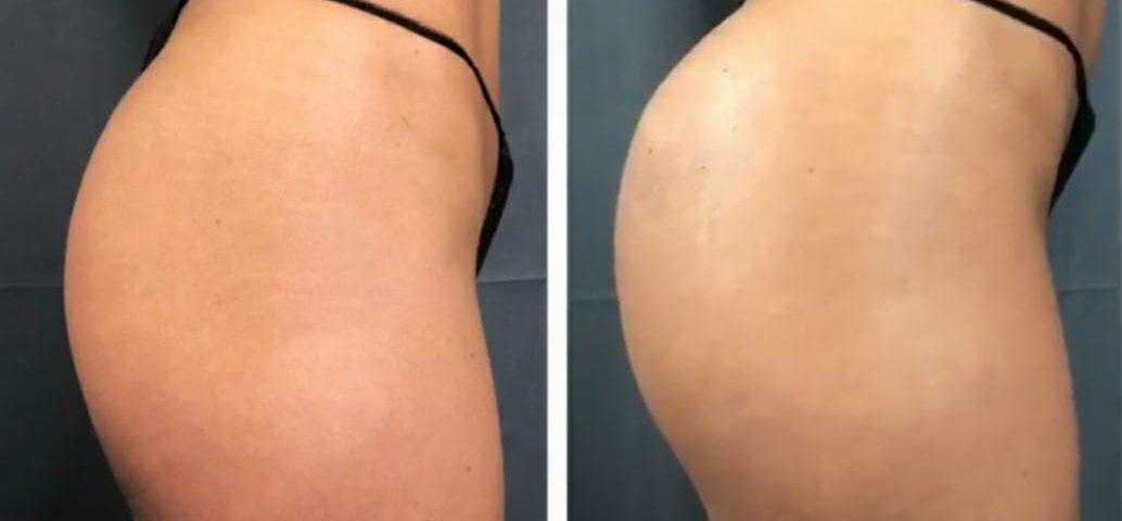 Preenchimento Corporal Plasma Gel | Clinica Estetica CM Barueri Bethaville