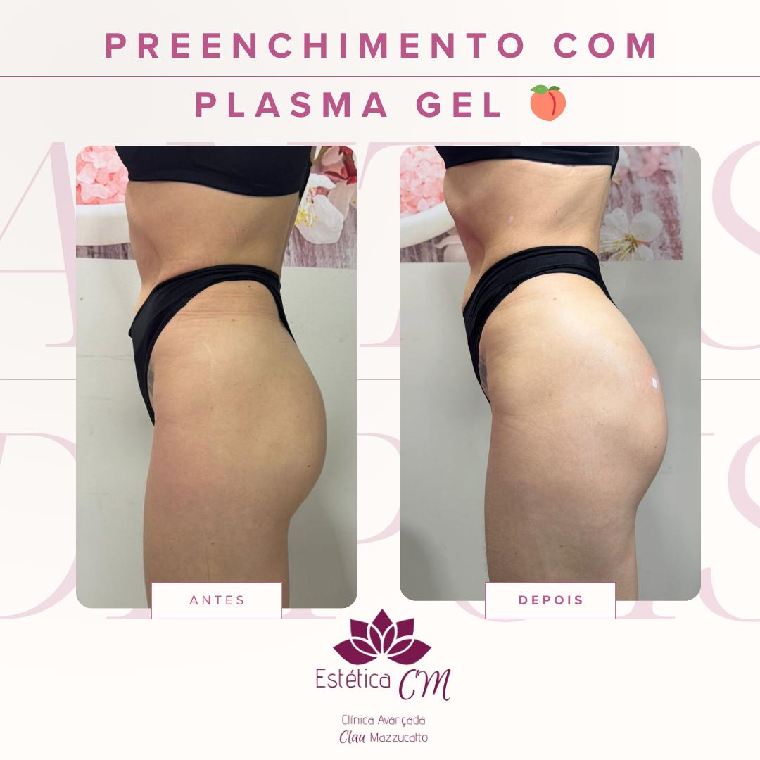 Preenchimento Corporal Plasma Gel | Clinica Estetica CM Barueri Bethaville