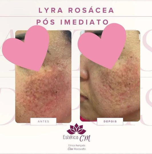 Agende avaliação para Lyra Rosacea | Estetica CM
