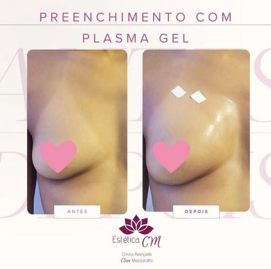 Preenchimento Seios | Estetica CM