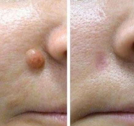 Agende Avaliação Jato de Plasma Extração de Verrugas | Estetica CM