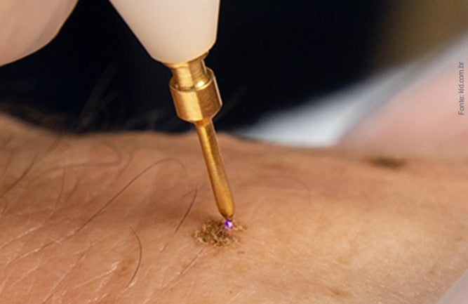 Agende avaliação Jato de Plasma Estrias | Estetica CM